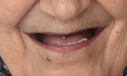 Nouveau sourire, nouvelle vie - Résultat final
